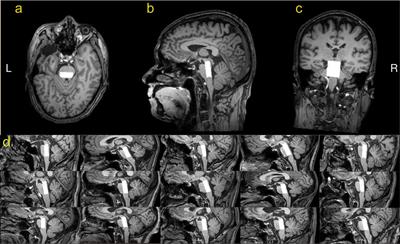 Feasibility of Measuring GABA Levels in the Upper Brainstem in Healthy Volunteers Using Edited MRS